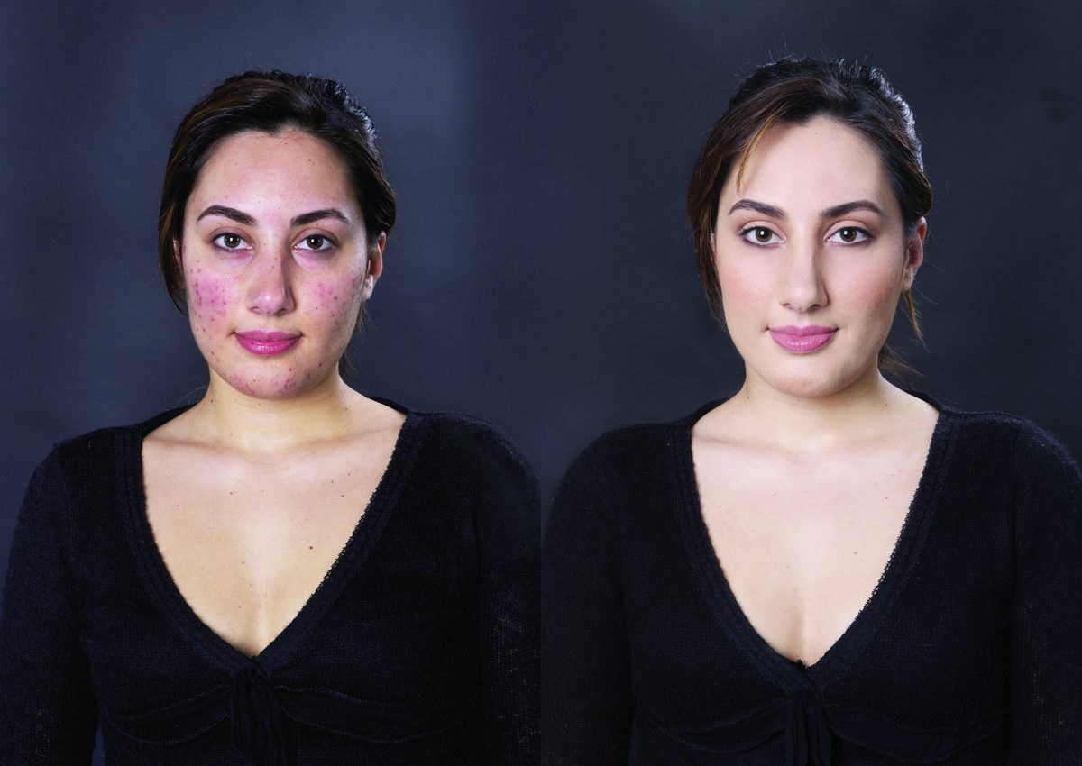 RiparCover before and after on Acne & redness
