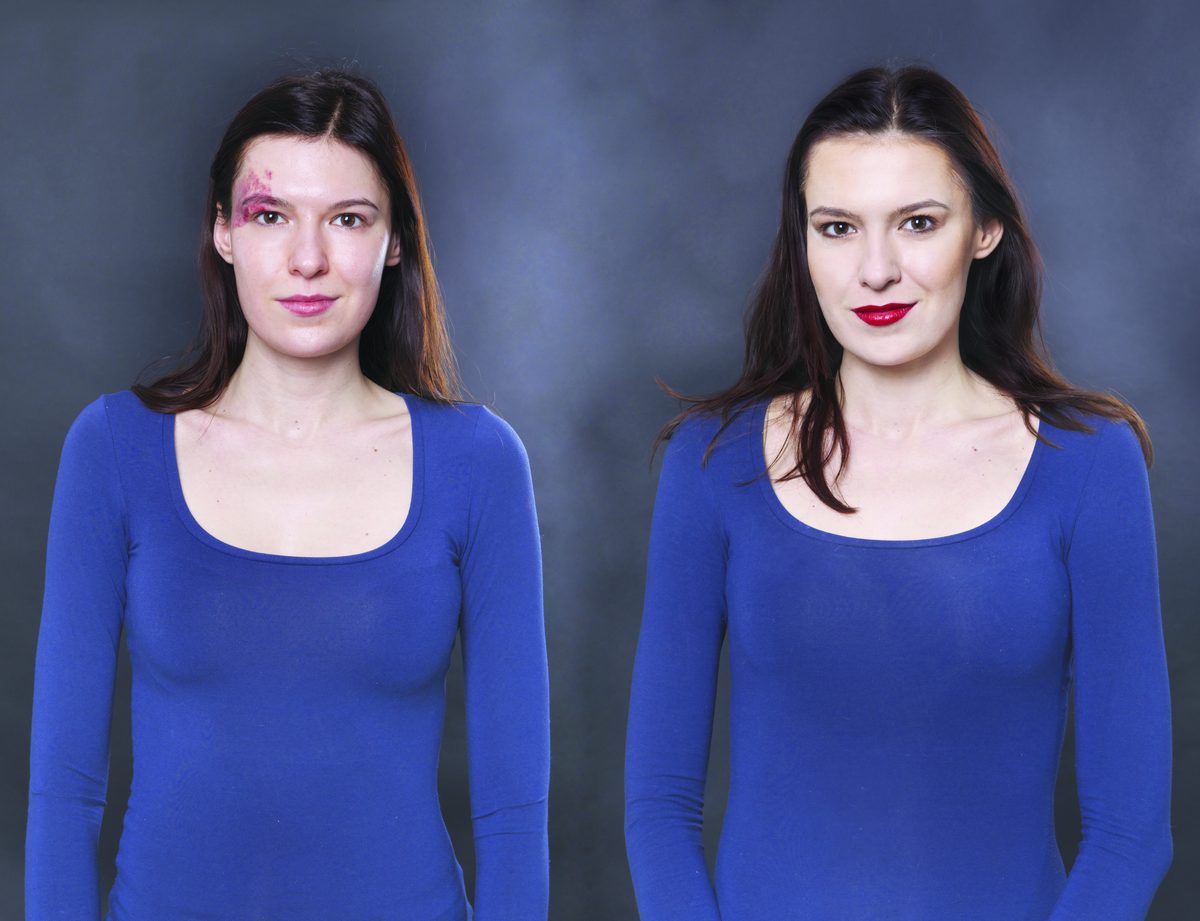 RiparCover before and after on Angioma